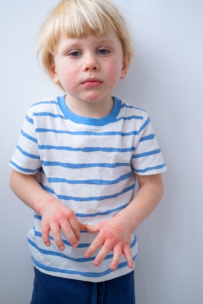 petit garçon avec éruption cutanée allergique ou eczéma sur le visage et les mains réaction allergique sévère peau atopique