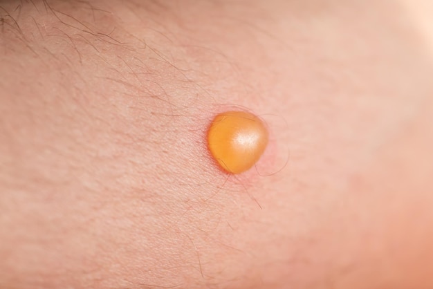 Petite ampoule orange sur la peau de près Macro prise de tumeur ou de brûlure sur la peau d'une jeune personne