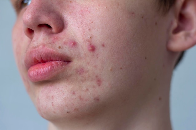 Une photo d'acné sur le visage d'un adolescent Boutons cicatrices rouges et points noirs sur les joues et le menton Le concept de soins de la peau à problèmes et de beauté