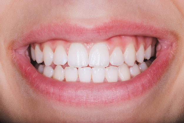 Photo d'une femme méconnaissable souriant vivement avec des dents avant de faire faire des travaux d'orthodontiste ou de dentiste.