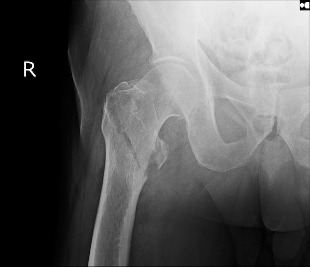 Photo de fracture de hanche xray photo