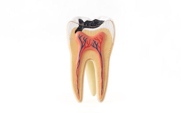 Photo isolée du modèle de structure dentaire interne avec destruction des caries sur fond blanc