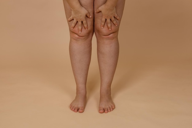 Photo recadrée d'une femme nue jambes nues pinçant la graisse sur les genoux Couper les plis graisseux Enlèvement de la graisse des genoux liposuccion de la peau œdémateuse Varices peau épaisse déshydratée Soins du corps Perte de graisse