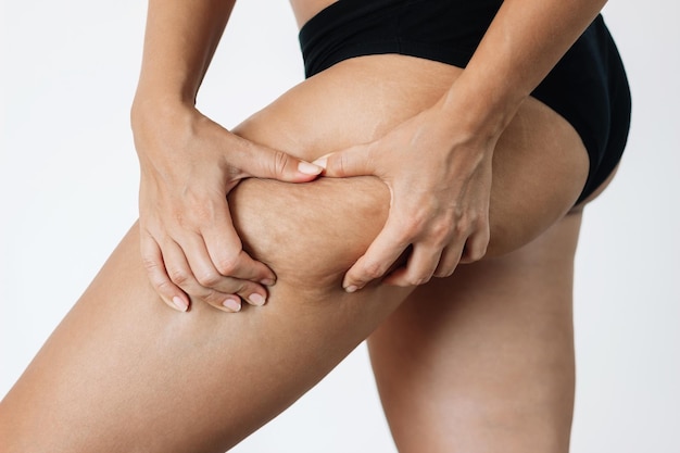 Photo recadrée d'une jeune femme bronzée saisissant la peau sur sa cuisse avec un excès de graisse et de cellulite