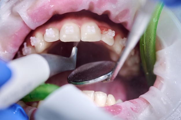 Photo photographie en gros plan vue supérieure du processus de nettoyage dans la bouche du patient nettoyage des dents avec un jet d'eau et un éjecteur de salive rétracteur de joue sur la bouche concept d'hygiène dentaire professionnelle