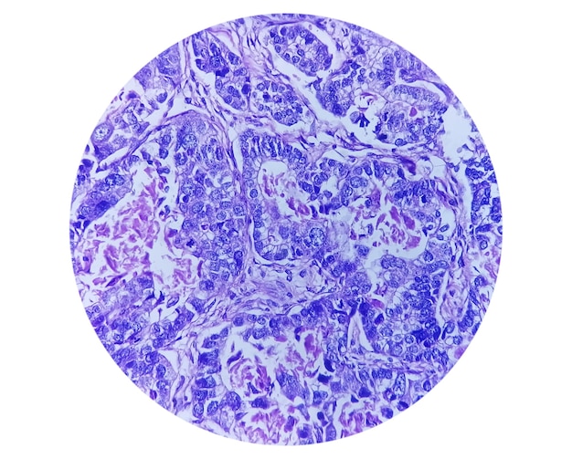 Photo photomicrographie d'adénocarcinome de l'estomac ou du cancer de l'estomac