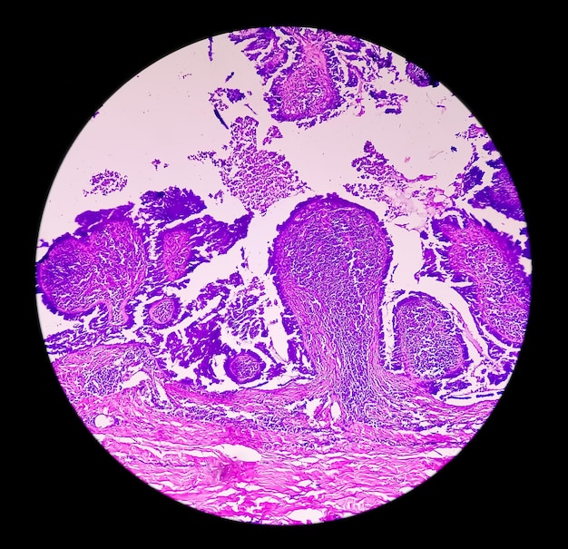 Photomicrographie du carcinome ou du cancer de l'endomètre pour le concept de sensibilisation au cancer de l'endomètre