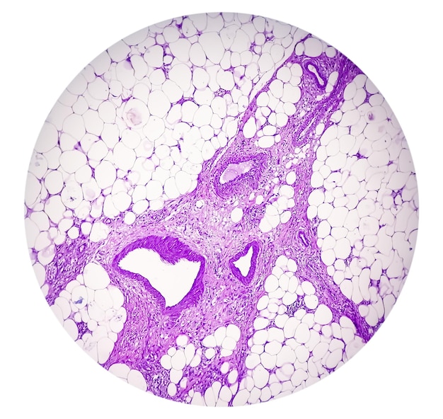 Photo photomicrographie de l'histologie du tissu granulomateux montrant un granulome à corps étranger