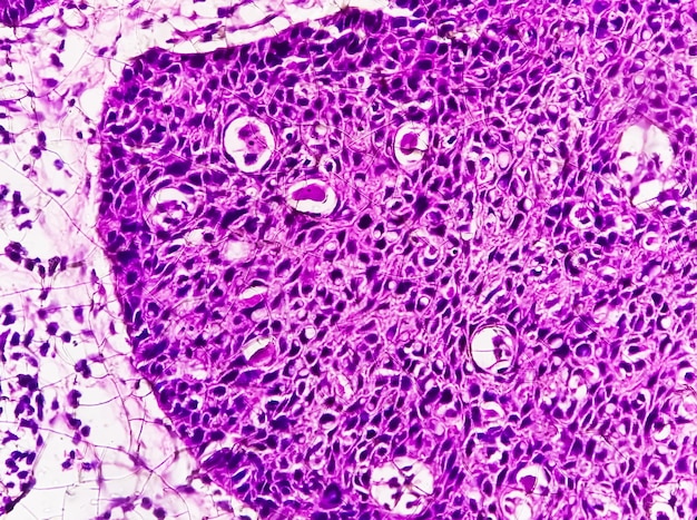 Photomicrographie montrant un carcinome épidermoïde de la langue de grade II. SCC invasif oral.