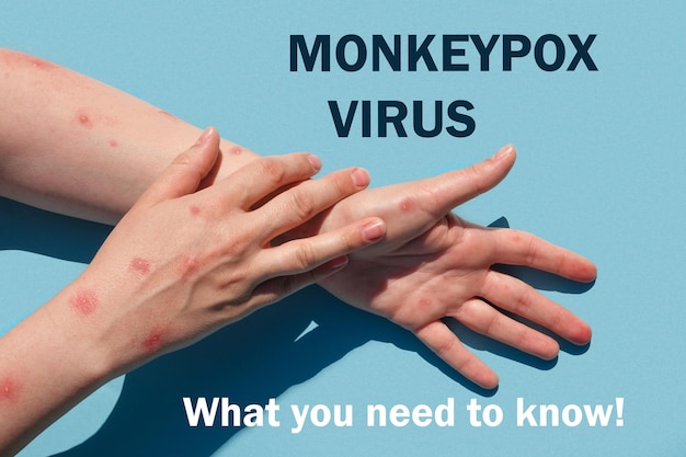 Phrase MONKEYPOX VIRUS ce que vous devez savoir Monkeypox nouvelle maladie dangereuse dans le monde Patient avec Monkey Pox Éruption cutanée douloureuse taches rouges cloques Gros plan des mains humaines avec problème de santé