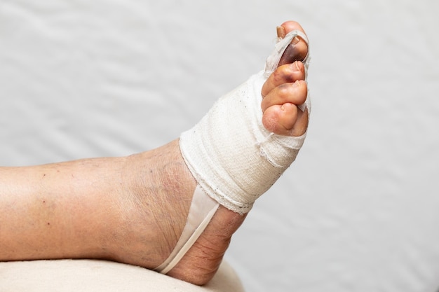 Pied bandé après opération correctrice hallux valgus