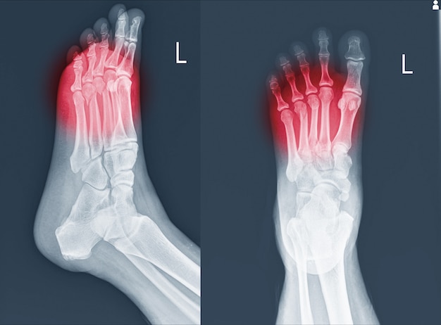 Pied et cheville aux rayons X montrant des fractures du métatarse.