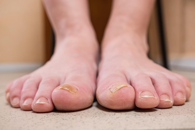 Pieds d'une personne infectée par un champignon sur un sol en carrelage blanc