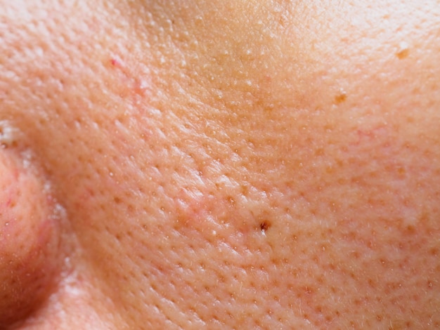 Photo pimple et l'acné sur la peau du visage, zoom macro.