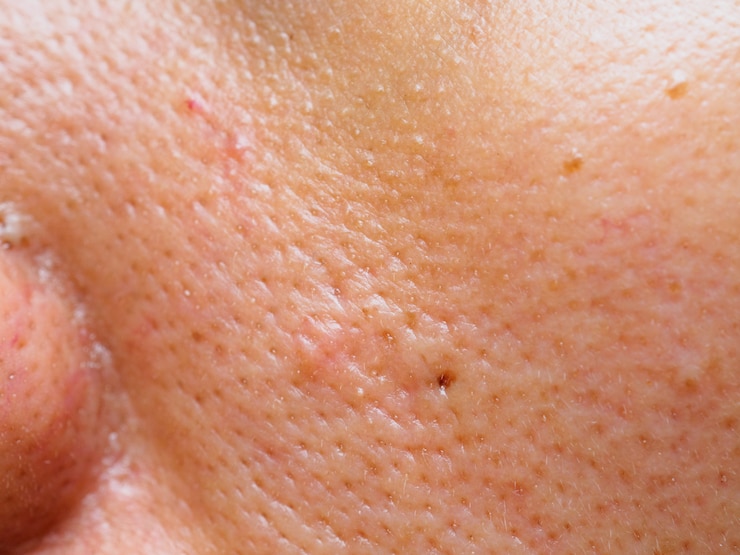 Photo pimple et l&#39;acné sur la peau du visage, zoom macro.