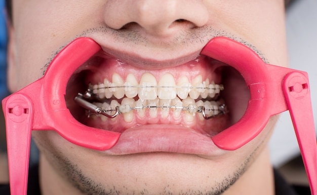 Plan macro sur des dents blanches avec des appareils orthodontiques et un écarteur dentaire au cabinet dentaire. Un traitement orthodontique. Dentisterie