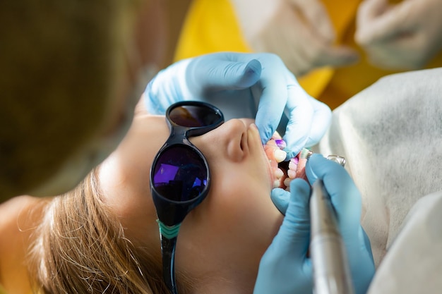 Plaque sur les dents de couleur rose et violetBain de bouche pour bébé Visite dentaire Dents avant et après le brossage et le blanchiment en une seule photo Examen préventif des enfants chez le dentiste