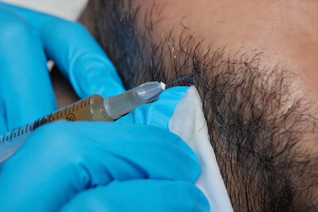 Photo plasma d'injection dans le docteur de cosmetologist d'homme de cheveux de barbe