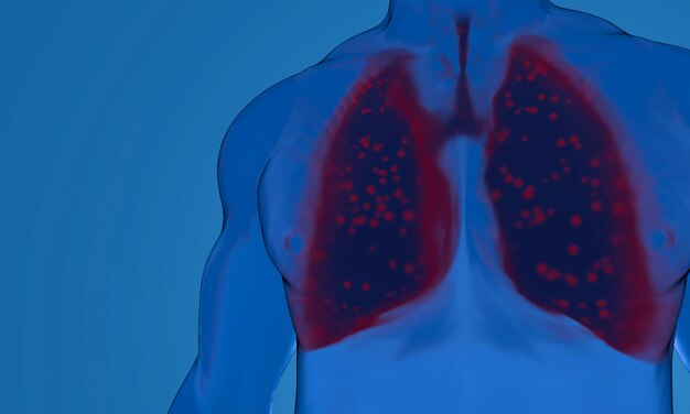 Pneumonie par coronavirus dans les poumons coronavirus attaquant les poumon avec une pneumonie sévère la désintégrant conduisant à la mort rendu 3D