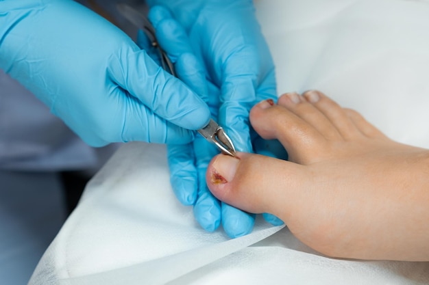 Photo un podiatre effectue la procédure d'élimination des ongles incrustés à l'aide de pinces