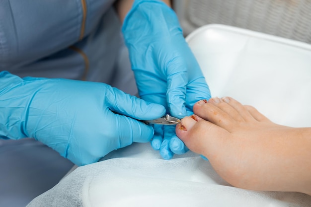 Photo le podologue pendant la procédure d'élimination des ongles incrustés avec des tondeuses