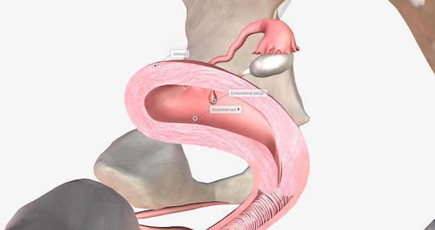 Photo les polypes de l'endomètre sont des excroissances anormales de la paroi interne de l'utérus appelée endomètre