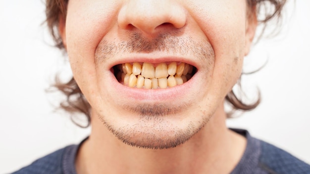 Portrait en gros plan dents de sourire homme jaune dents laides de fumer maladie d'alcool tordu sale