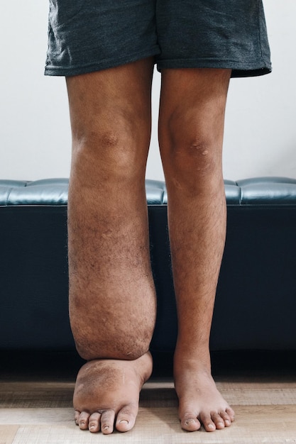 Photo portrait de jambes avec filariose ou filariose lymphatique patient souffrant d'œdème