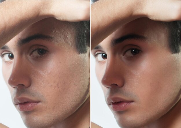 Portrait d'un jeune homme avant et après une opération esthétique