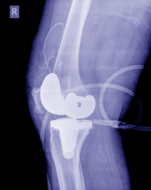 Post-opératoire De L'image Radiographique Genou De Remplacement Du Genou Droit.