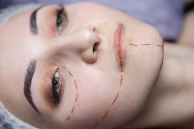 Préparation à la chirurgie plastique. Jeune mannequin à la clinique avec des lignes de perforation sur le visage.