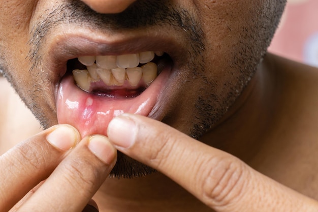 Photo près d'un ulcère de la bouche d'un homme indien