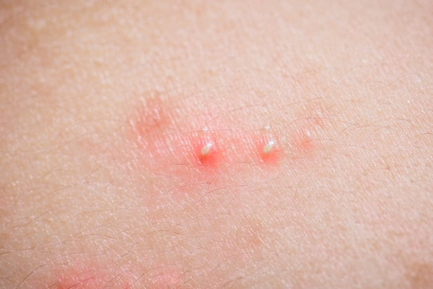 Problème De Santé, Closeup Jeune Fille Acné Sur Le Dos.