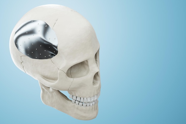 Procédure médicale opération d'ostéosynthèse repositionnement chirurgical du crâne Fixation d'un os cassé avec une technologie de plaque métallique fixation d'une fracture Rendu 3D Illustration 3D