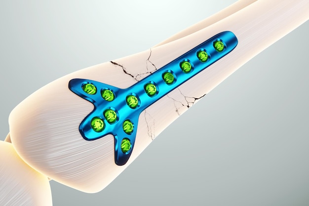 Procédure médicale opération d'ostéosynthèse repositionnement chirurgical des os de la jambe Fixation d'un os cassé avec une technologie de plaque métallique fixation d'une fracture Rendu 3D Illustration 3D