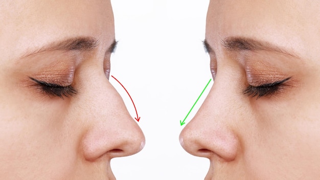 Un profil du visage de la femme avec le nez avant et après la rhinoplastie Comparaison après la chirurgie plastique