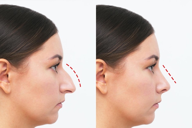 Un profil du visage de la femme avec le nez avant et après la rhinoplastie isolé sur fond blanc.