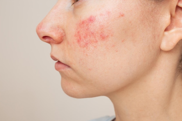 Profil en gros plan d'une femme souffrant de la maladie chronique de la peau rosacée sur son visage acné rose