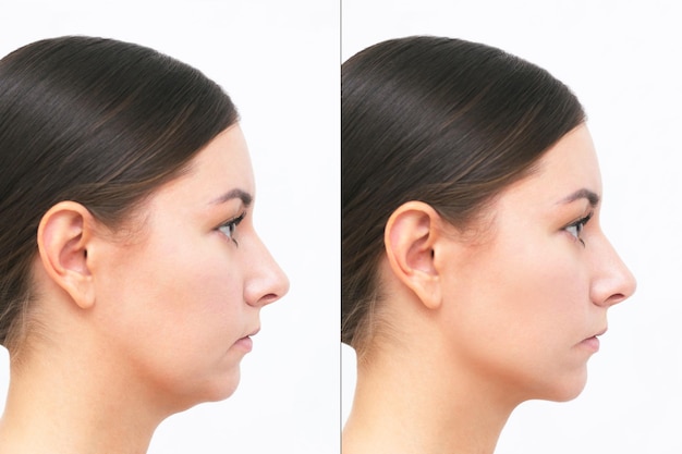 profil d'une jeune femme avec un menton avant et après les procédures cosmétiques de liposuccion Comparaison
