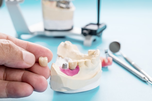 Prosthodontie Implantaire Ou Prothèse