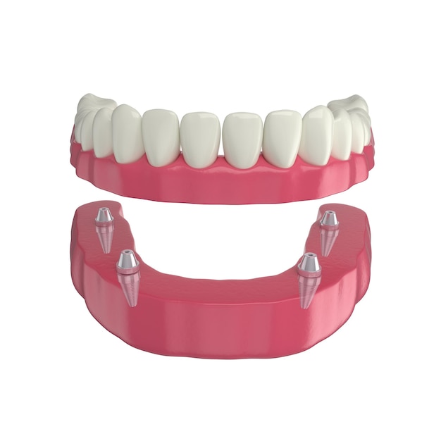 Photo prothèse dentaire, 4 implants overdenture, arc inférieur, rendu 3d