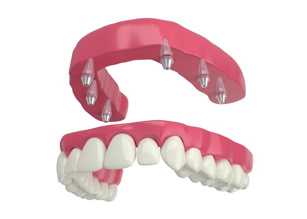 prothèse dentaire, 6 implants overdenture, arc supérieur, rendu 3d