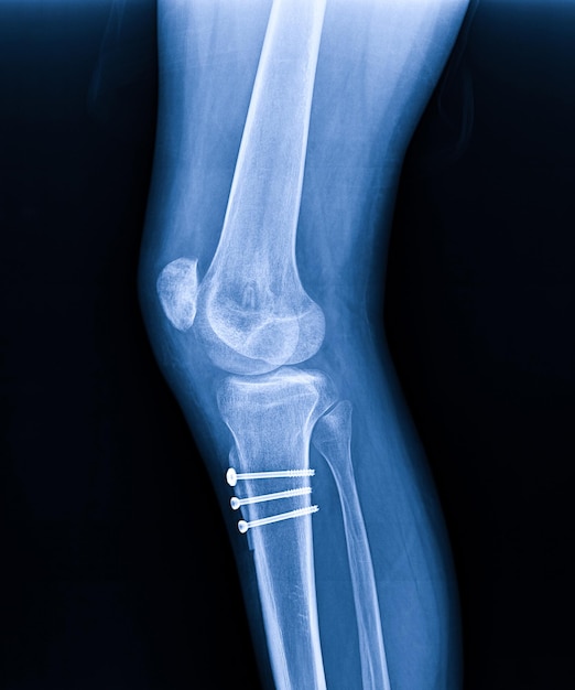 Radiographie de l'articulation du genou Fracture proximale du tibia et Fracture post-fixation du tibia proximal avec plaque et vis surlignées en rouge