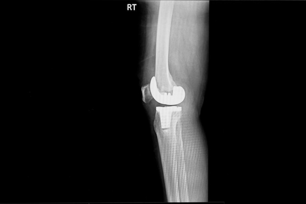 Radiographie des articulations latérales et antéropostérieur du genou droit avec remplacement total du genou.