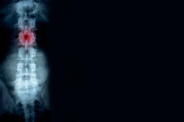 Radiographie de la colonne vertébrale avec un lieu de blessure avec fond d'espace copie