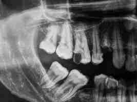 Photo radiographie des dents humaines en noir et blanc