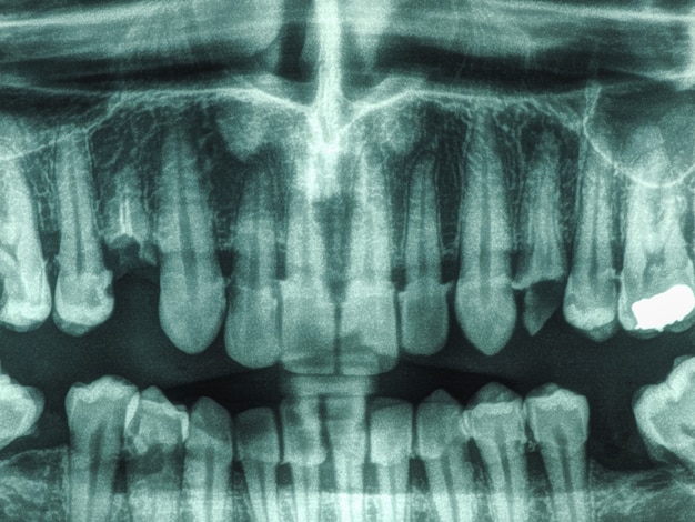 Photo radiographie des dents humaines