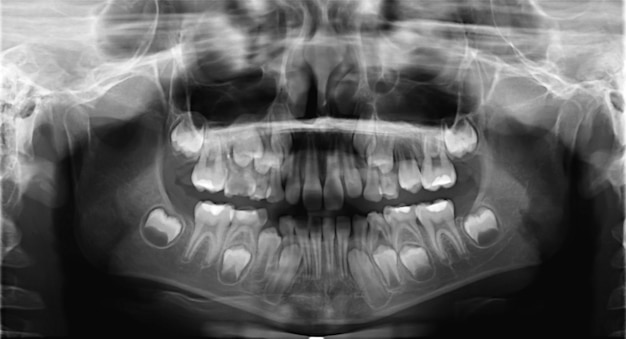 Photo radiographie des dents de la mâchoire des enfants image négative panoramique du visage de l'enfant