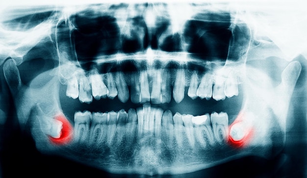 Photo radiographie des dents