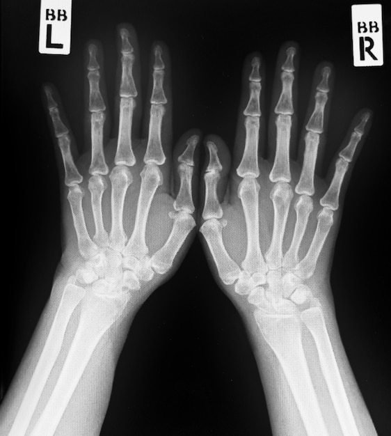 Radiographie des deux mains humaines. Mains humaines normales.